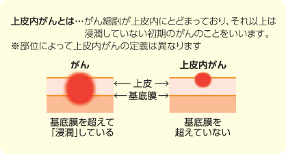 上皮内がんとは